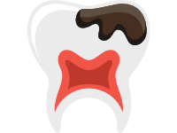Cavity