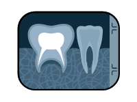 X Ray of a Tooth