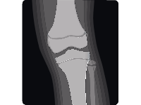 X Ray Of A Foot